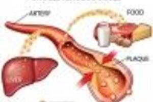 Chế độ ăn trong bệnh rối loạn chuyển hóa Lipid